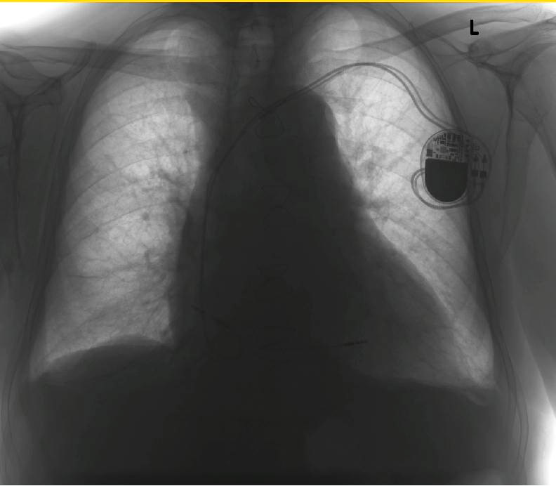 Stymulator serca widoczny na zdjęciu rentgenowskim